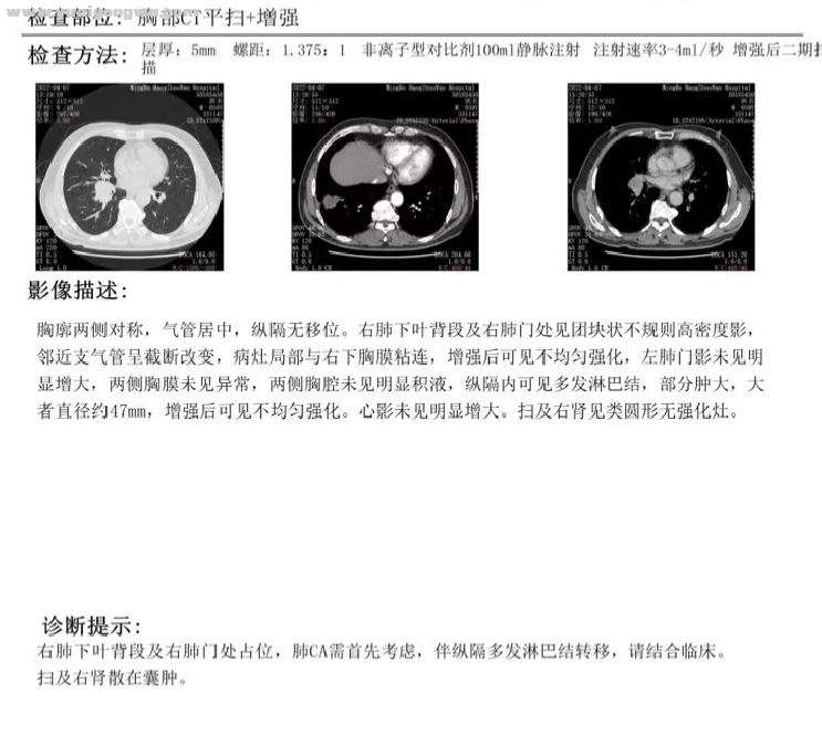 胸部CT