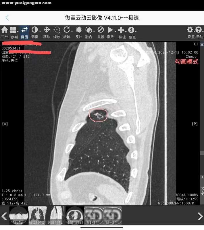 肺部高危结节3-5.jpg