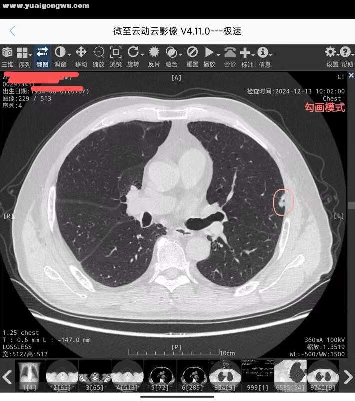 肺部高危结节2-5.jpg